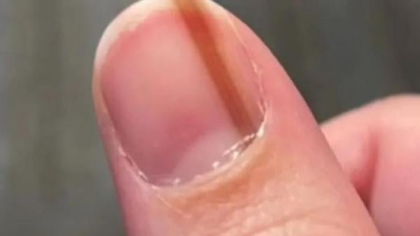 عانت من خط تحت ظفرها لـ 10 سنوات ثم اكتشفت المفاجأة الصادمة