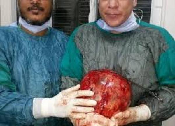 استئصال ورم يزن 13 كيلو من بطن مسن بمستشفى جنوب مصر