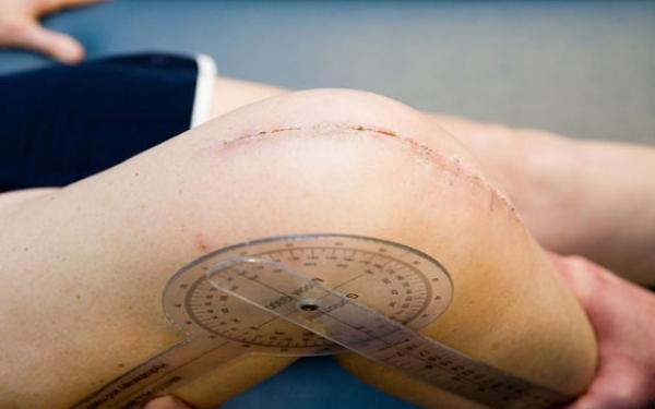 جراحات الركبة الأكثر شيوعاً قد تؤدي إلى التهاب المفاصل