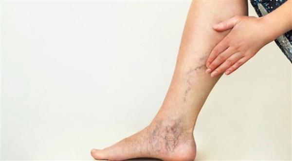 ارتفاع مخاطر الإصابة بدوالي الساقين بسبب قلة الحركة