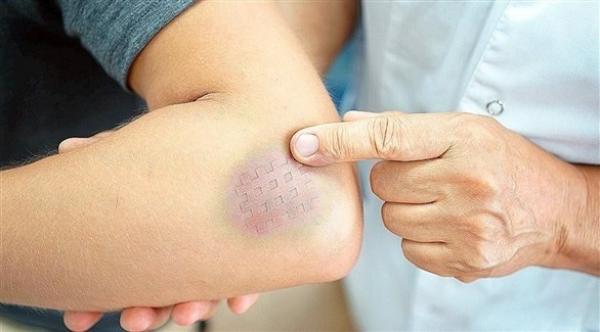 البقع الزرقاء على الجسم قد تكون مؤشرا على أمراض خطيرة