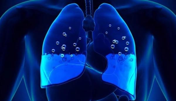 ما هو الانصباب الجنبي و ما هي أعراضه و طرق علاجه؟