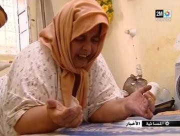 معاناة سيدة مع داء الفيل‏