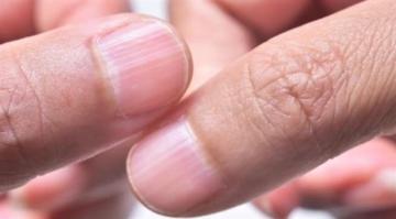 ما هي دلالات الخطوط  الرأسية والأفقية للأظافر؟