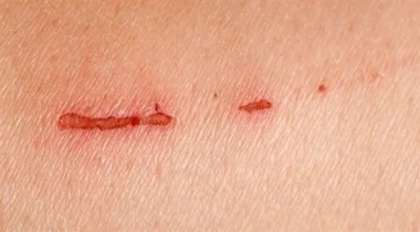 هذه الفيتامينات تساعد على تسريع شفاء الجروح