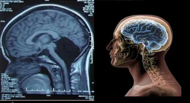 السكتة الدماغية تسرق 8 سنوات من وظائف المخ