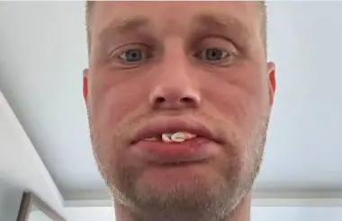 بريطاني سافر إلى تركيا لتجميل أسنانه لكنه فقدها كلها  !