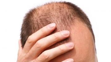 هل يحمي الصلع المبكر من سرطان البروستاتا؟