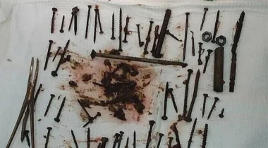 العثور على 152 جسماً معدنياً داخل معدة روسية