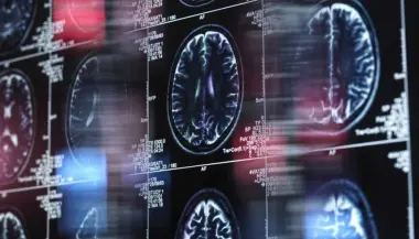 عقار KCL-286 يفتح مساراً بحثياً جديداً لعلاج الزهايمر