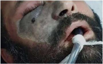 معلومات هامة عن مرض "الفطر الأسود" الذي بدأ يهدد حياة المصابين بفيروس كورونا
