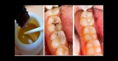 وصفات طبيعية تخلصك من تسوس الأسنان (فيديو)