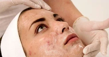 أربع طرق للتخلص من الرءوس السوداء