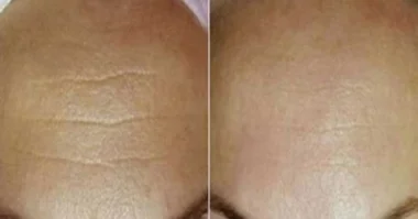 الحل النهائي للقضاء على التجاعيد خلال 7 أيام!