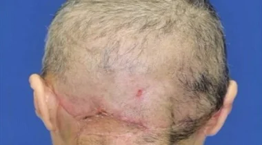 فقدت فروة رأسها بالكامل بآلة غزل القطن