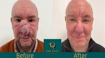 عملية تجميل ناجحة لرجل يعاني من  حالة جلدية نادرة