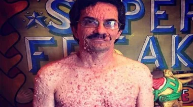 أمريكي يعيش مع آلاف الفقاعات على جسده
