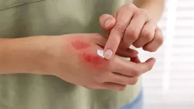 علماء روس يبتكرون هلاما نانويا يُسرع التئام الجروح العميقة