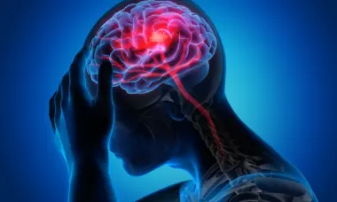 سباق مع الزمن لإنقاذ الدماغ.. السكتة الدماغية تهدد الشباب أيضاً