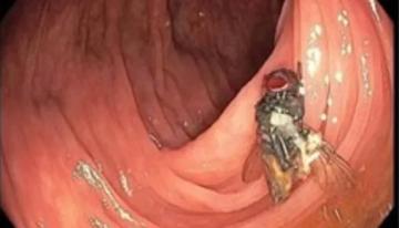 العثور على ذبابة حية تطن داخل أمعاء رجل