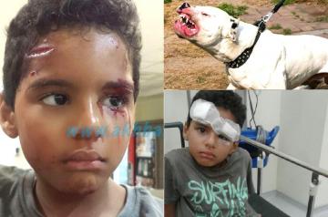 حصريا و بالصور : كلب من فصيلة " بيتبول " يمزق وجه طفل صغير نجى من الموت بأعجوبة‏