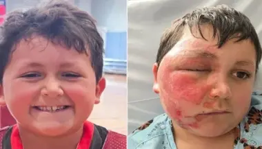 تحدٍ متداول على تيك توك يتسبب في إصابة طفل بحروق خطيرة