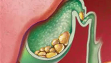 مشروب طبيعي لطرد رمال المرارة من الجسم