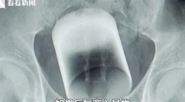 أطباء يكتشفون كأساً زجاجياً داخل أمعاء رجل