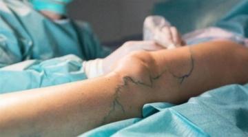 في أي وقت يجب استئصال دوالي الساقين؟