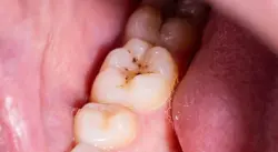 جل جديد يعيد بناء مينا الأسنان المتضررة دون استخدام الفلورايد