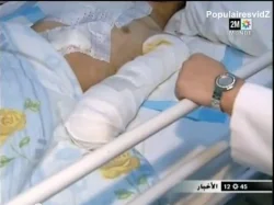 حروق بليغة تؤدى الي بتر يدي طفل حاول تسلق عمود كهربائي