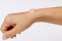 أكياس العقد العصبية.. كتل حميدة قد تعود رغم تفريغها