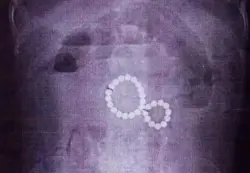 أطباء ينقذون حياة طفلة ابتلعت 29 كرة مغناطيسية