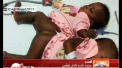 عملية نادرة لفصل نوأمين بالهند