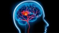 السكتة الدماغية .. أعراضها وطرق علاجها