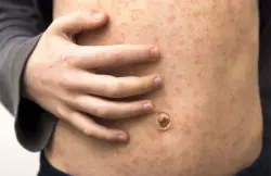 تفشي وباء الحصبة في إسرائيل بوتيرة متسارعة وتسجيل عدد من الوفيات بين الأطفال