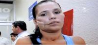 في المكسيك .. ثلاثة أطباء و ممرضة يستخرجون قنبلة يدوية استقرت في وجه امرأة !  
