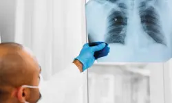 سرطان الرئة.. لماذا يصعب اكتشافه مبكراً؟ هذه علامات لا يجب تجاهلها