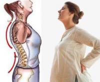 معلومات هامة عن هشاشة العظام