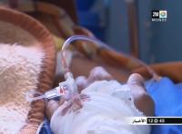 إعادة يد مبتورة بمستشفى مراكش‏