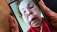عمليات تجميل غريبة تجتاح المكسيك وتسبب تشوهات للسيدات