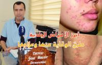 في حديث لـ"أخبارنا": الدكتور السباعي يقدم نصائح مهمة للمصابين بـ"الأمراض الجلدية" من الوقاية إلى العلاج (فيديو)