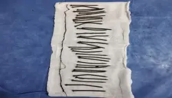 مصر.. فريق طبي ينقذ سيدة ابتلعت 34 مسمارا