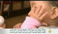 طفلة من دون أمعاء دقيقة ومرارة تُحير الأطباء