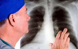 علماء يكشفون سر انتشار سرطان الرئة لدى غير المدخنين
