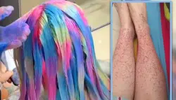 شابة صينية تصاب بالتهاب في الكلى بسبب تقليد نجم K-pop وتغيير لون شعرها شهرياً