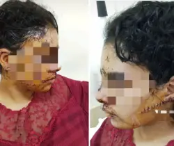 اعتداء وحشي على سيدة بتازة..طليقها يشوه وجهها بعد معاناة طويلة من العنف والاغتصاب