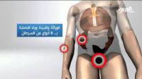 دراسة حديثة: السرطان سببه الجينات أو الحظ السيء!
