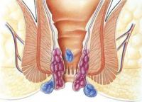 مرض البواسير أسبابه وأعراضه وعلاجه