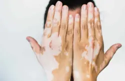 من  هم الاشخاص المعرضون للاصابة بالبهاق؟